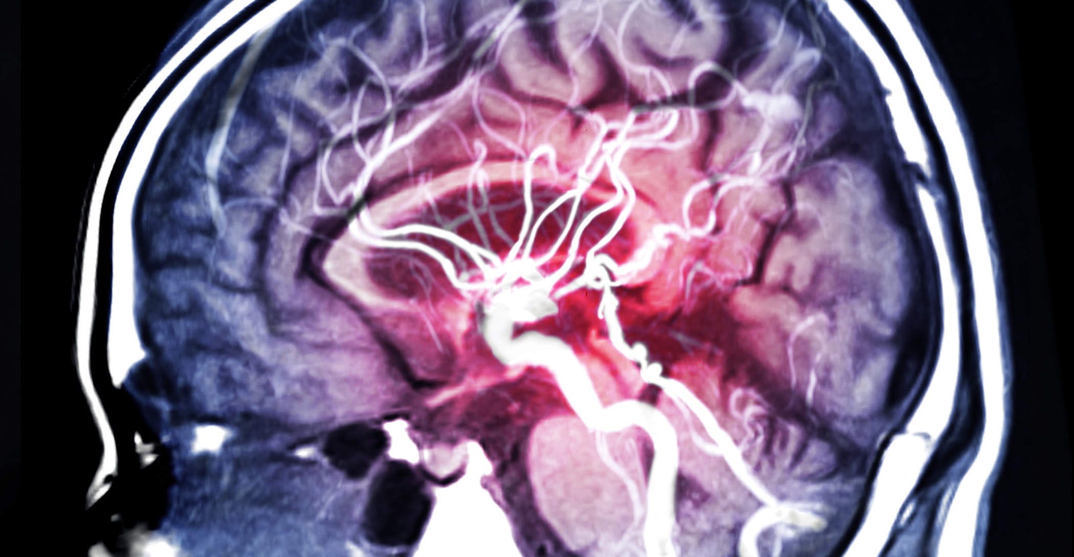 Does Cannabis Cause Strokes?